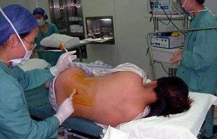 老婆剖腹产三个月, 缝针部位流水, 老公自责没照顾好她