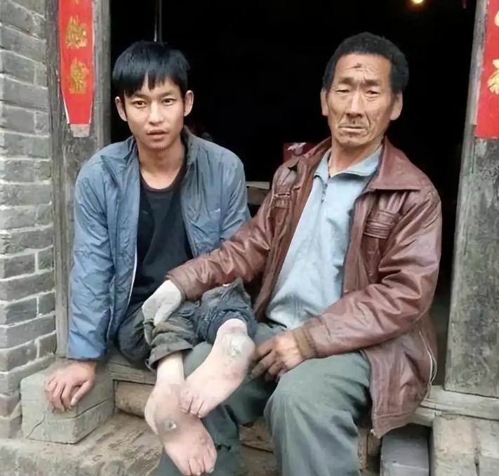 1991年，河南一对夫妻生下残疾儿子，不想要，直接扔进草丛。村里一个大龄单身汉却