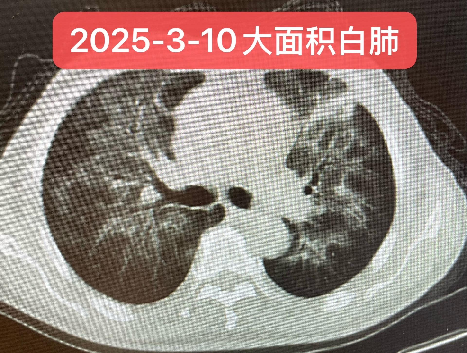 胃癌患者的间质性肺炎。患者男，62岁，既往：2024年1月8号行腹腔镜...