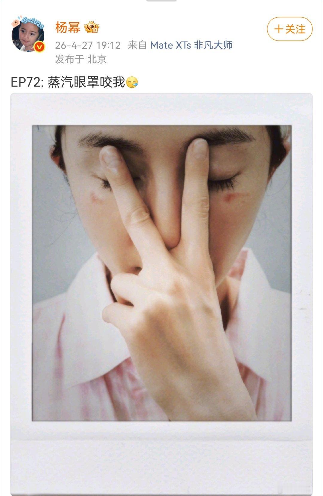 杨幂脸被烫伤了，会不会毁容，毕竟靠脸吃饭杨幂脸被蒸汽眼罩烫伤了