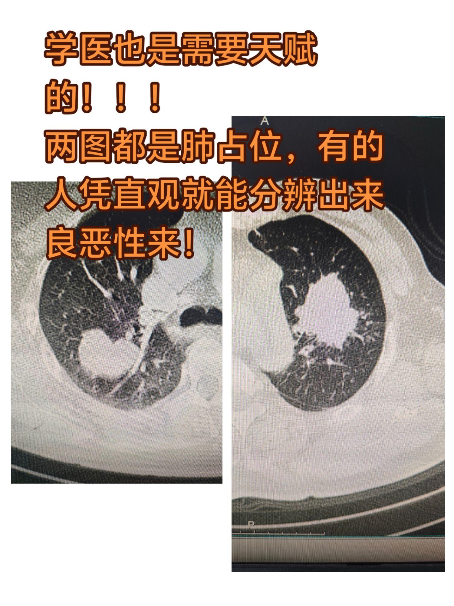 肺占位 肺癌 肺良性肿瘤。学医也是需要天赋的！！！ 两图都是肺占位，有...