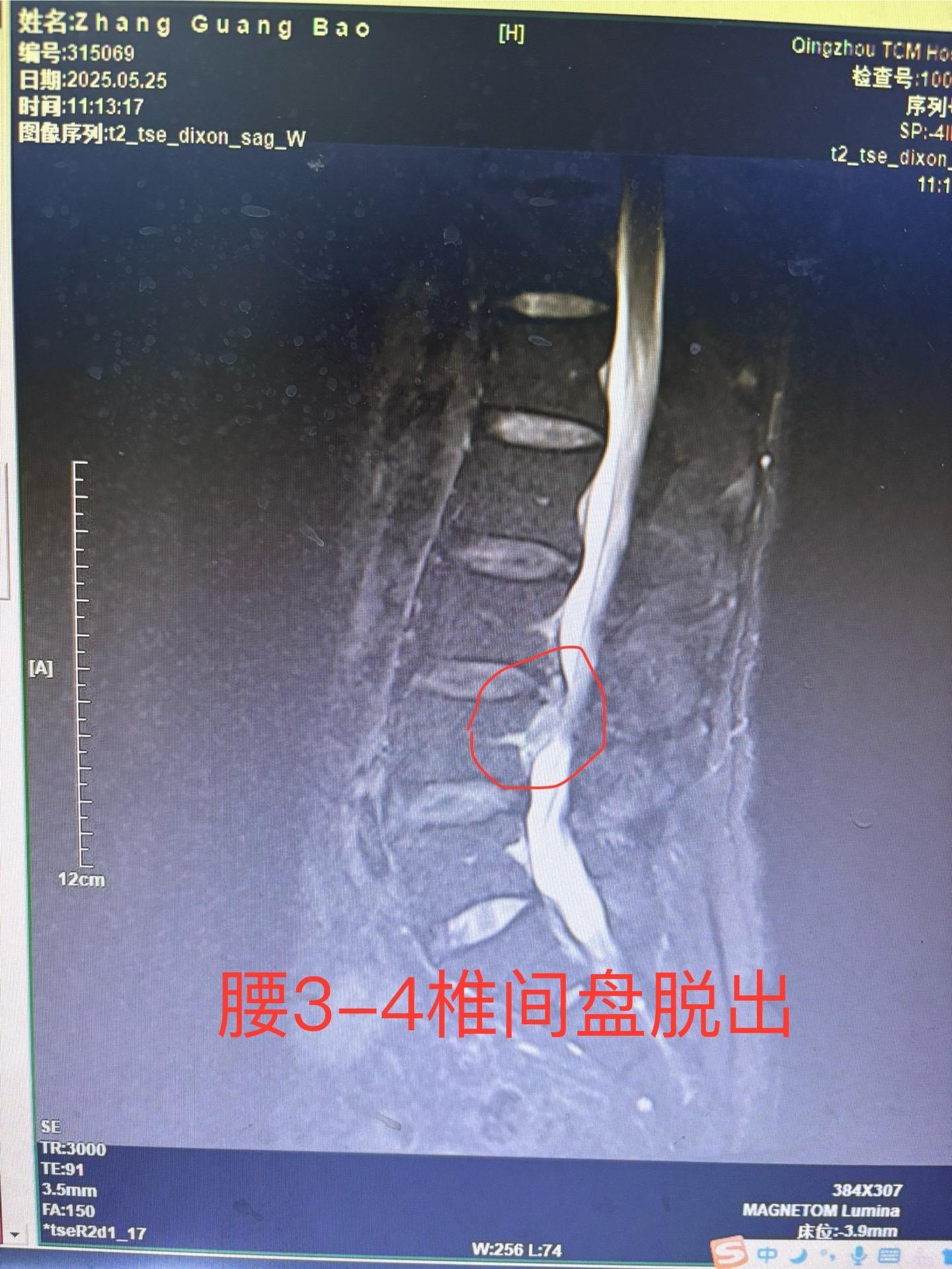 前段时间发现一例椎间盘突出病人保守治疗突出自行吸收，最近又发现一例治疗...