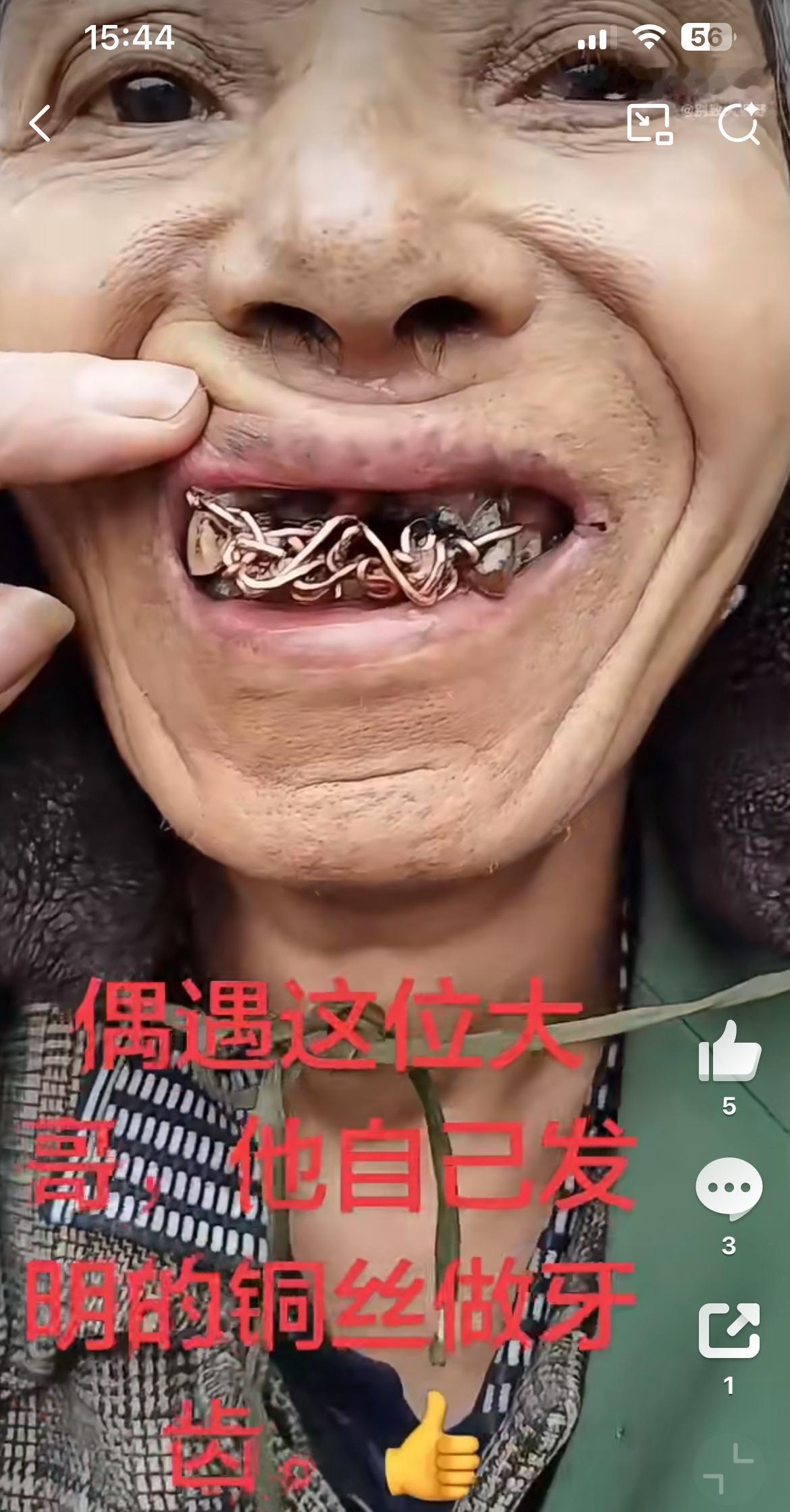 看着好心酸，四川乡镇赶集看到一大爷一口铜丝搅的牙齿，牙齿全掉了，没办法咀嚼。换假