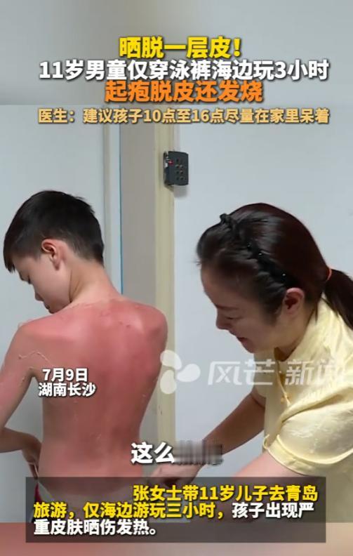 “太吓人了！”7月9日，湖南长沙，一名11岁男孩被太阳晒脱一层皮，浑身通红，还发