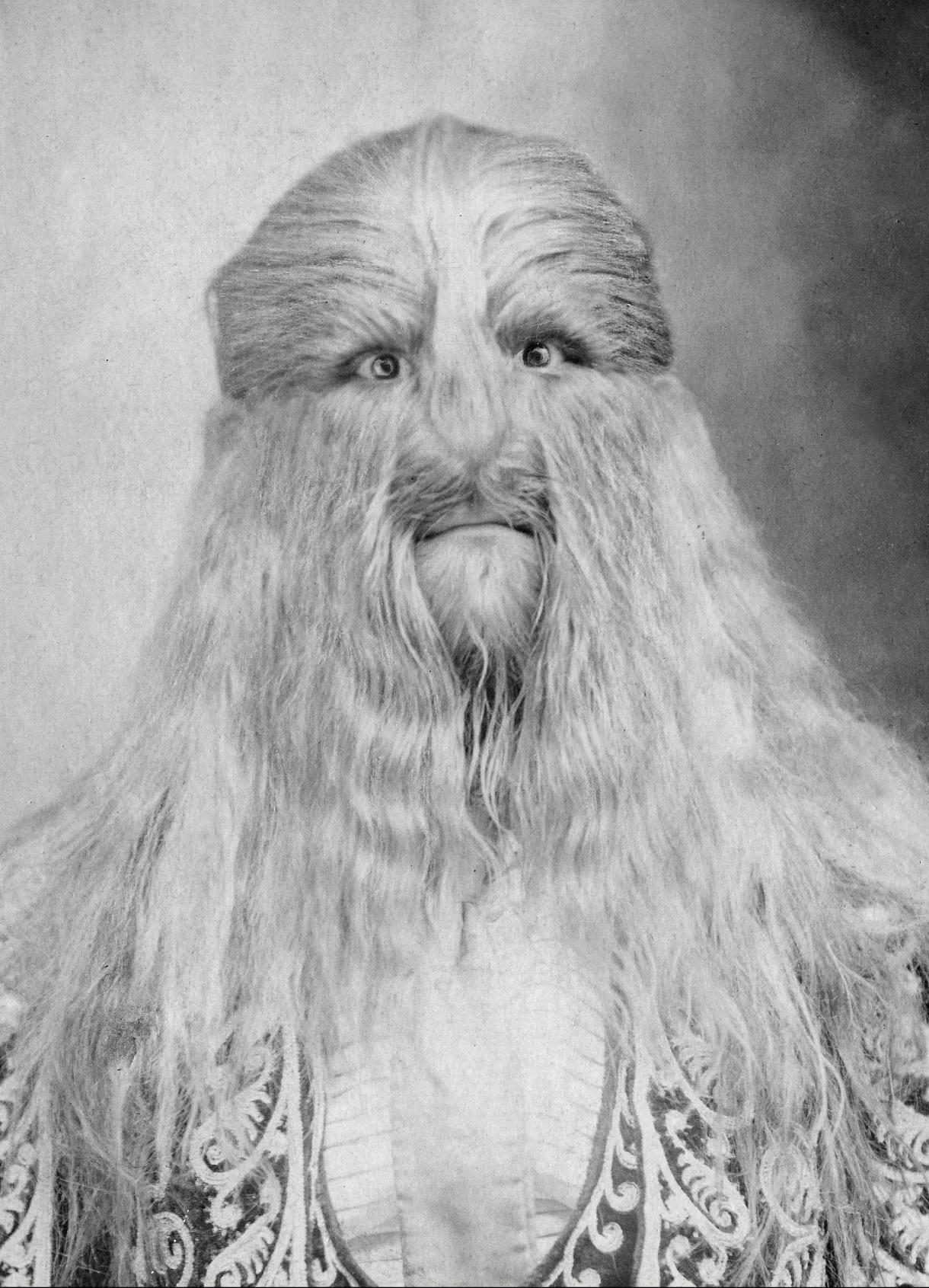 1890年,波兰男孩莱昂内尔因患罕见的先天性多毛症,全身覆盖浓密毛发,面部毛发厚