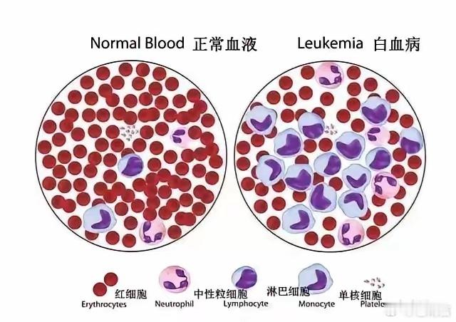 白血病的早期表现白血病的早期症状七个典型表现要牢记！白血病的早期七大典型表现这种