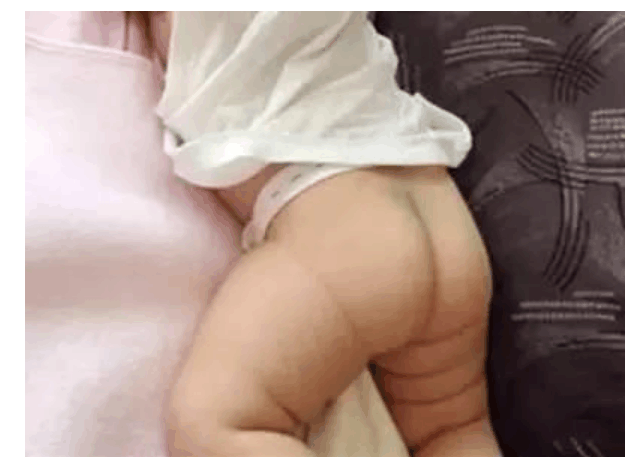 你家宝宝屁股上有青斑吗? 为什么会有青斑的出现