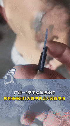 细思极恐！广西钦州，一4岁半女孩在洗澡时，被哥哥用打火机零件电伤，导致女孩右肩严