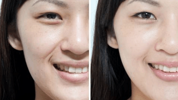 如何快速的消除法令纹 3103808887158433786.jpg?id=0