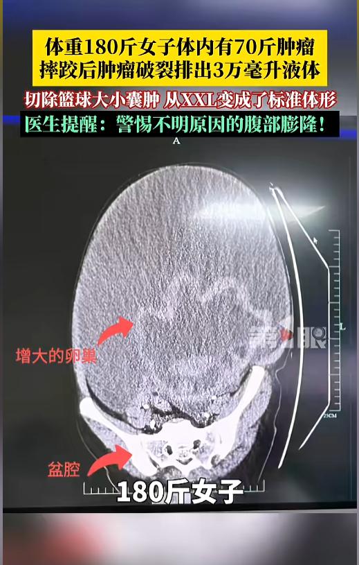 “离大谱！”浙江女子减肥多年，180斤体重纹丝不动，没想到摔了一跤后，肚子突