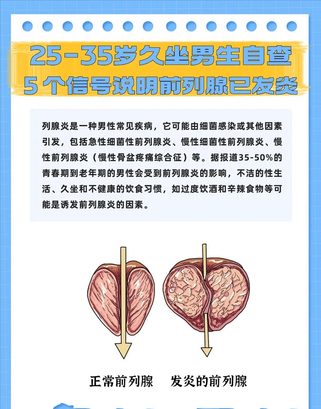 25‑35岁久坐男性对照自查，5个信号提示前列腺发炎