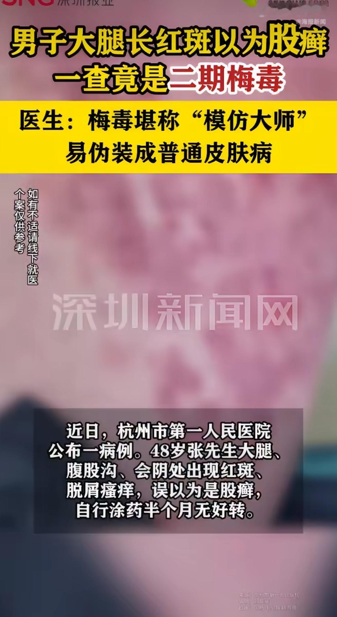 “害人又害己！”杭州48岁的张先生，大腿根又红又痒还掉皮屑，他断定自己就是普通股