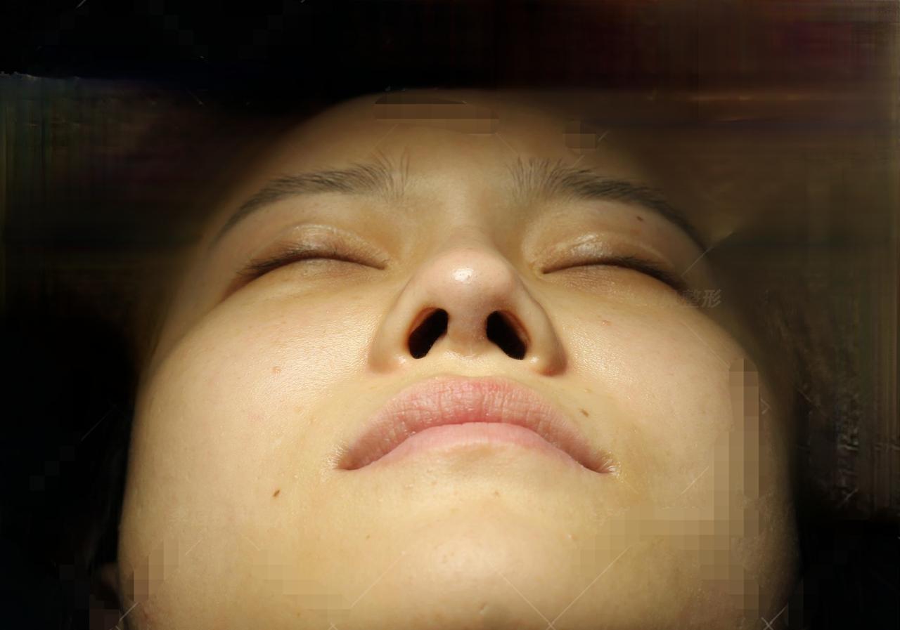 湖南长沙，一女子去隆鼻，打完麻药睡了一觉醒来，医生却告诉她，他和医美机构价格没谈