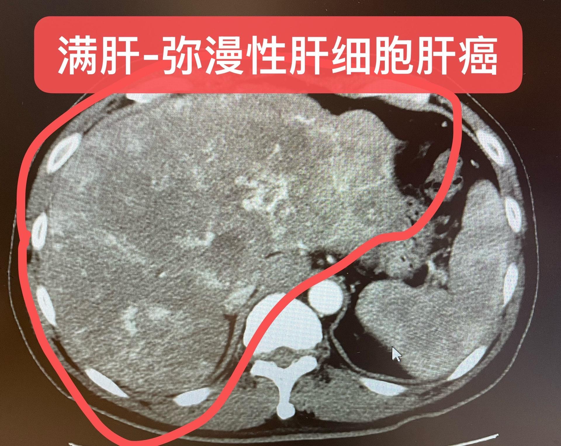 满肝弥漫性肝细胞肝癌：挽救治疗。男，49岁，乙肝病毒高度复制，长期未体...