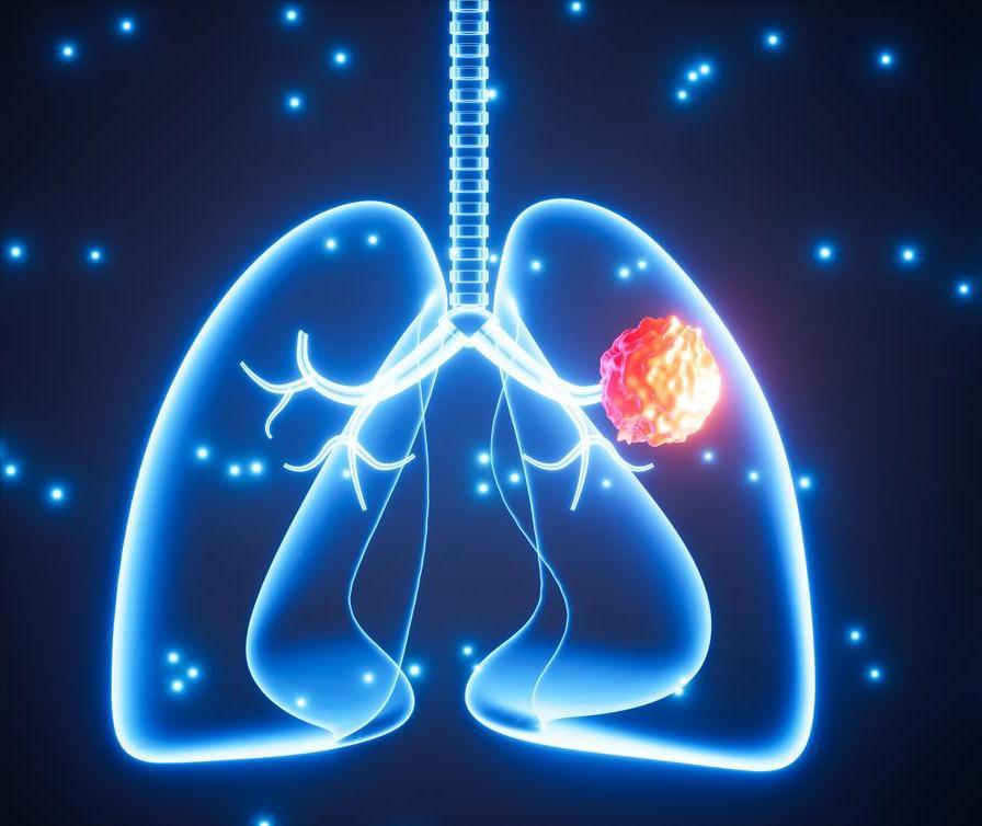 肺部疾病呢最怕是多种疾病一起发生，比如说慢阻肺合并间质性肺病，慢阻肺合并肺癌，间