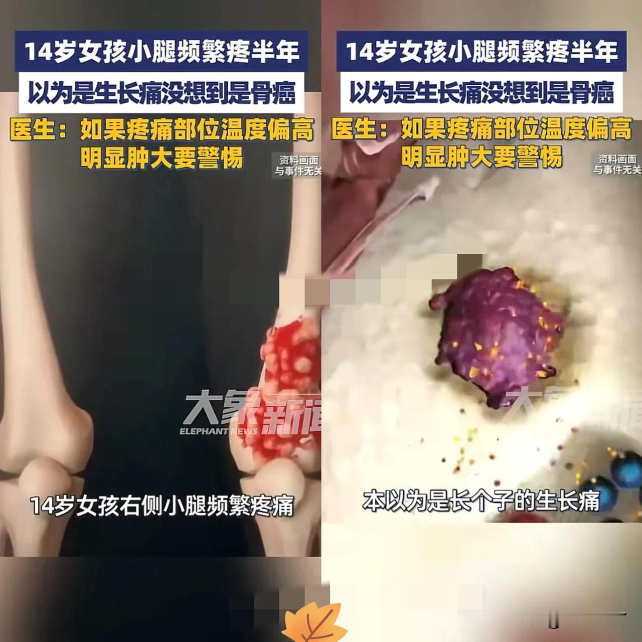 河南郑州，一女孩小腿频繁疼痛，家长以为是生长痛，没当回事，没想到半年也没减轻，甚