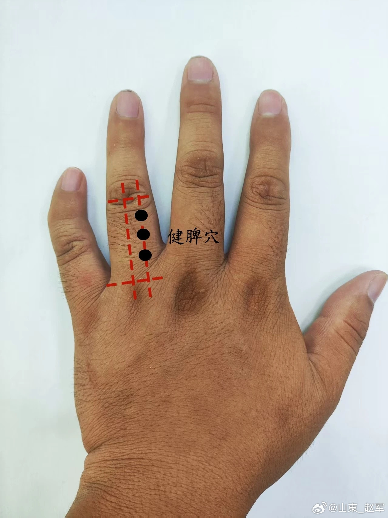 青春痘粉刺，健脾穴健脾穴源自董氏奇穴位置：在手背面，无名指第一节中央偏拇指侧三