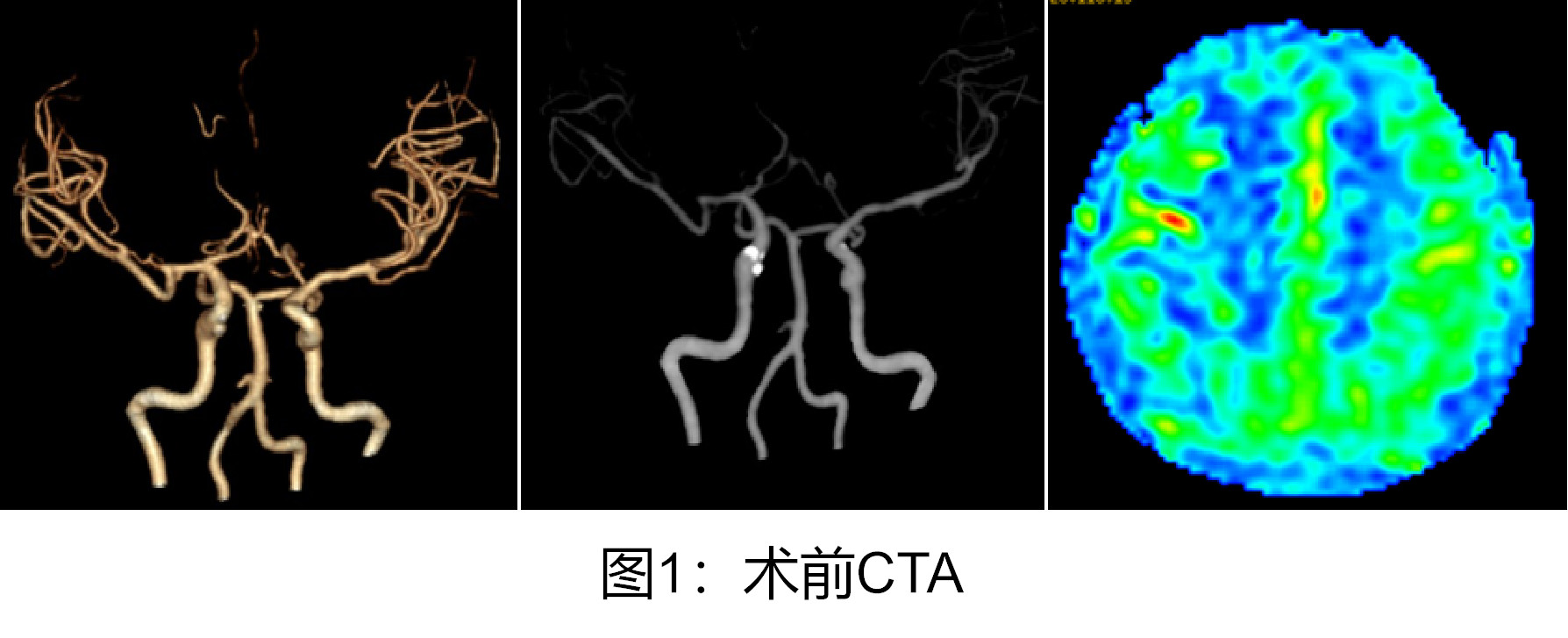 【脑子里也会“烟雾缭绕”？56岁阿姨脑出血，元凶竟是罕见“烟雾病”】🧠💨一场突如其来的意识障碍，