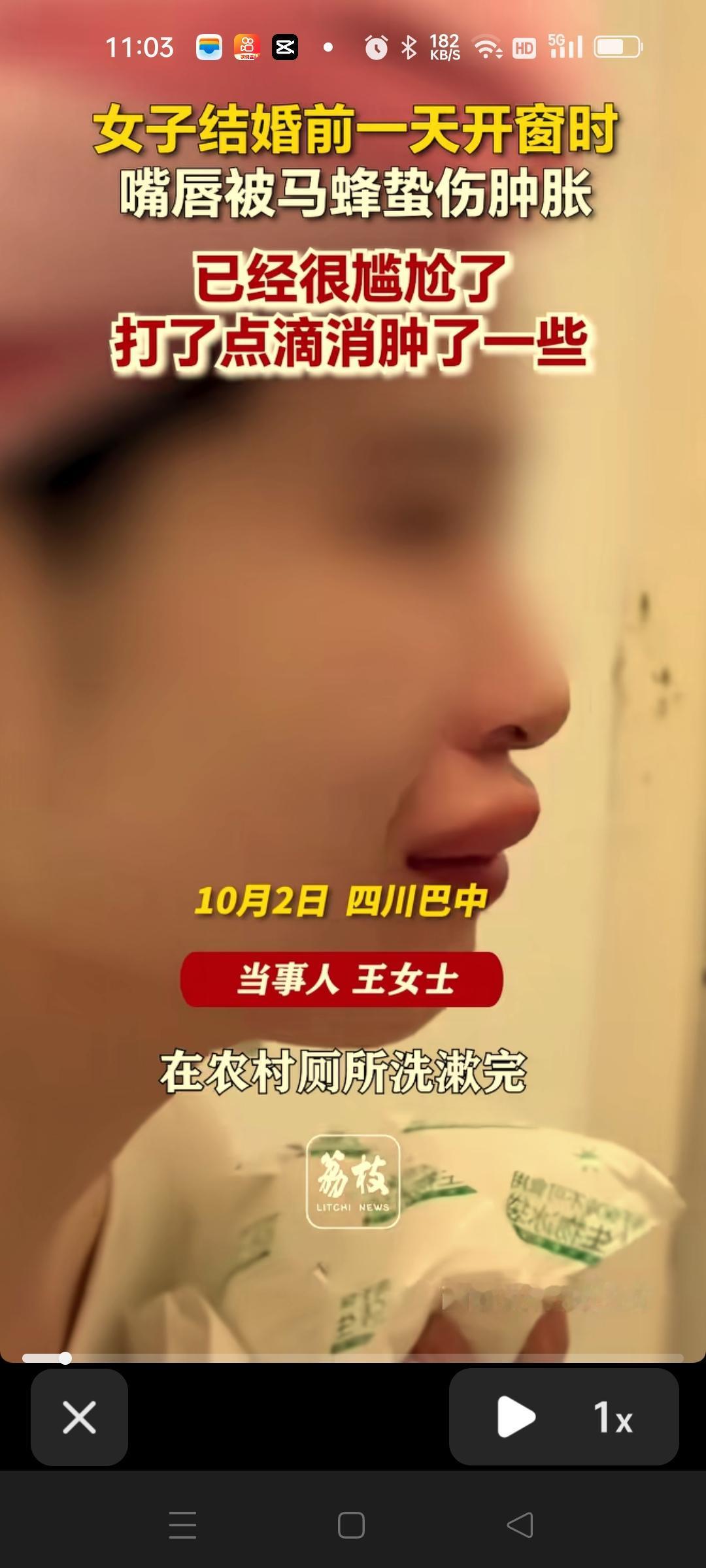 四川的王女士在婚礼前一天嘴被蜜蜂咬了。被蜜蜂咬了以后，嘴唇马上肿的很高，第二天