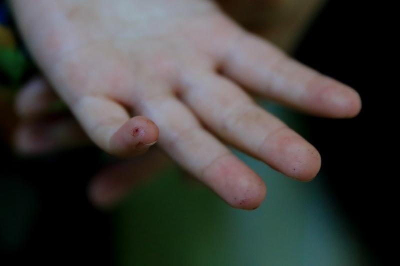 糖友不仅要控糖更要防“疹”糖友们可别只盯着血糖，还得防“疹”！糖尿病易引发皮肤