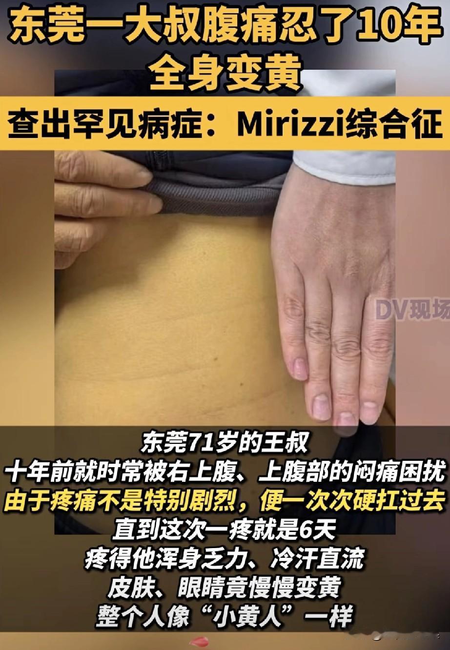 忍了10年腹痛，他竟变成“小黄人”！医生：这病比胆结石凶险10倍71岁的东
