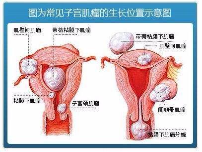 女子腹部鼓胀如孕妇 宫颈肌瘤在作祟