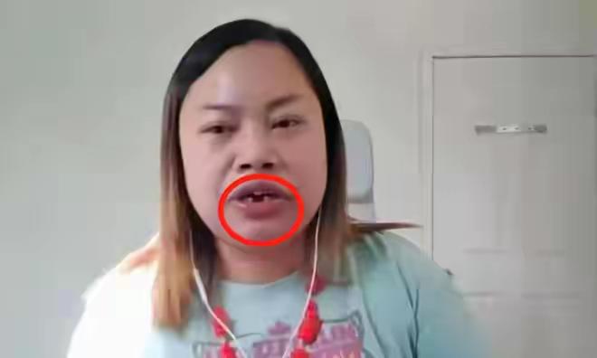 初代网红凤姐牙齿没了，也不敢去补牙！凤姐作为我国初代网红，在美国已得到了绿卡，