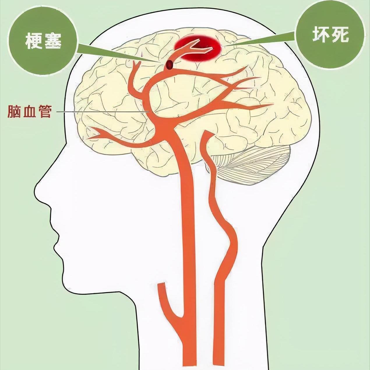 同样是脑梗为什么他好了你还没好？这三个差距是关键1.态度不同曾经我就见证