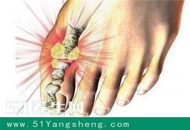 痛风的“救星”终于找到了, 每天吃一点, 高尿酸不攻自破!