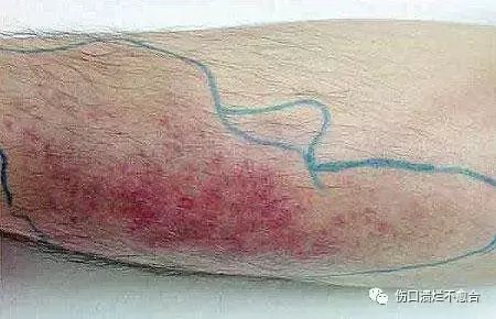 皮肤溃疡的同胞兄弟你都知道吗? 看看他们都叫啥!