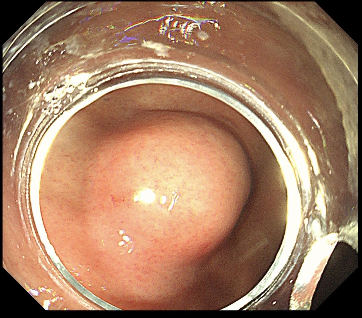 胃黏膜下隆起都是间质瘤吗？不是的！这个很像间质瘤的胃黏膜下隆起，其实是...