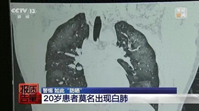 5岁男孩突然双肺大面积变白，竟与妈妈用的这东西有关！医生紧急提醒：用错了很危险