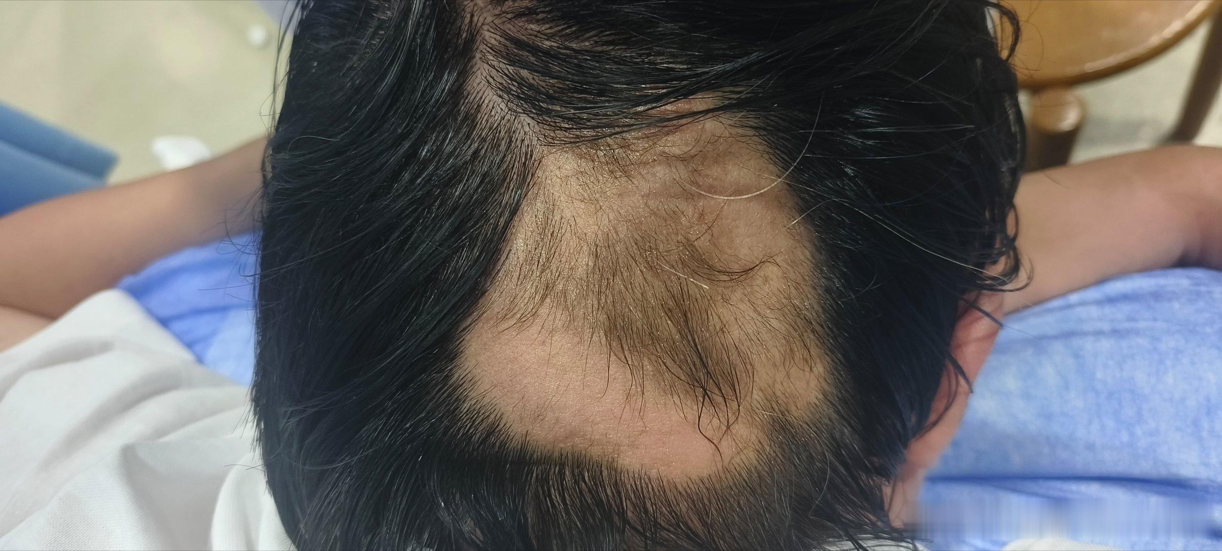 斑秃针灸治疗中治疗针灸杭州