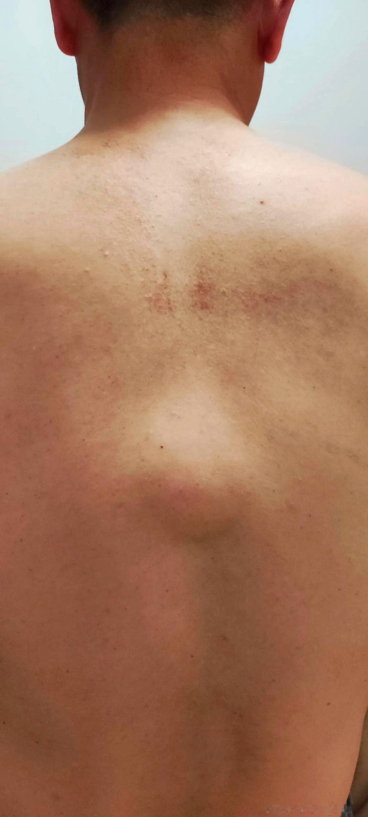 后背悄咪咪长了颗“鸡蛋”，老婆急得跳脚我却说放着呗？那天热得跟蒸笼似的，我穿着