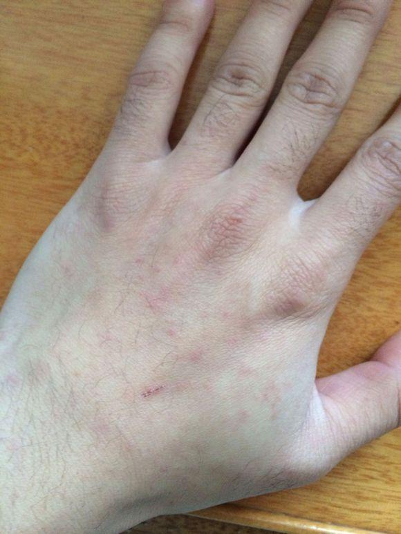 专家想详解: 过敏性紫癜有后遗症么?