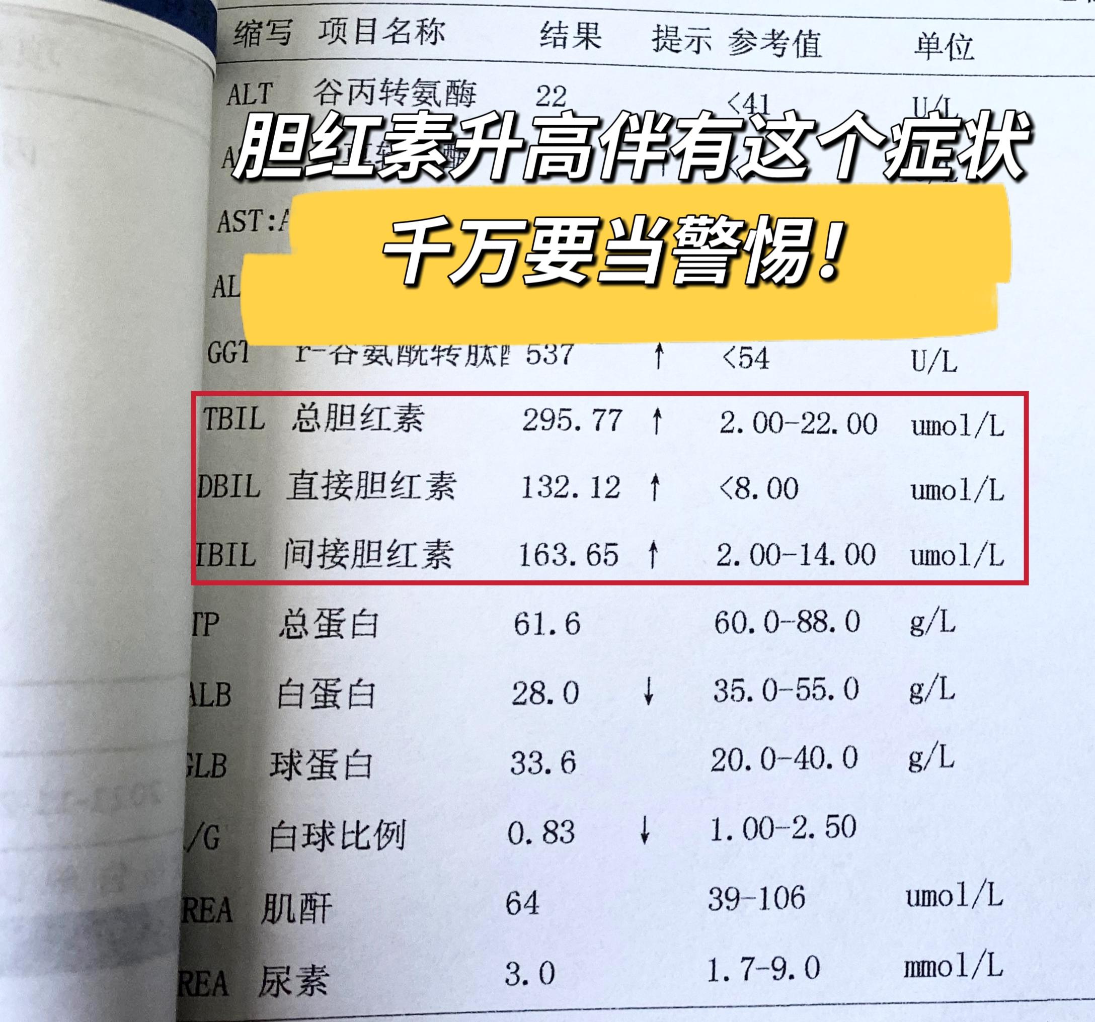 肝病患者注意！胆红素升高伴有这个症状的时候，就要警惕了！  这个症状就...