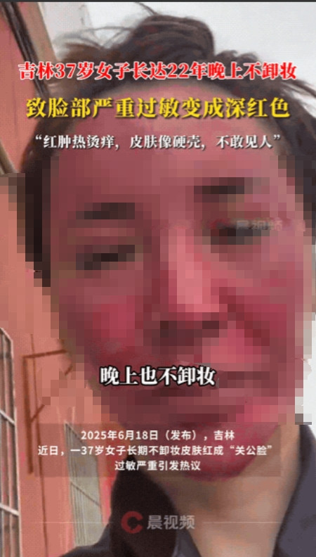 “真是活久见！”吉林，一女子因为太懒，22年来居然从来都没卸过妆！导致现在脸部严