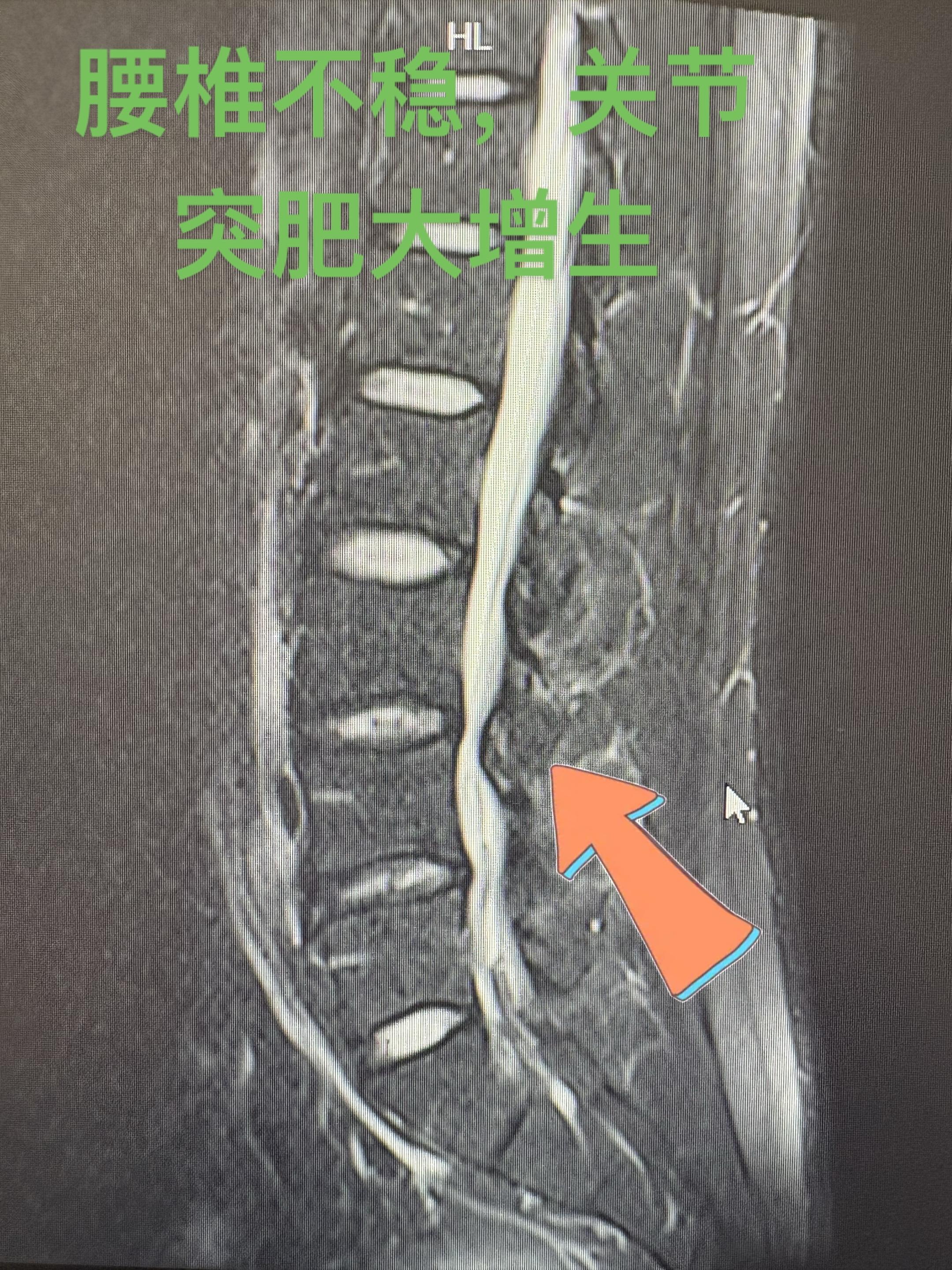 腰椎退行性变。一种常见的 腰椎不稳，造成关节的肥大增生，挤压神经的空间...