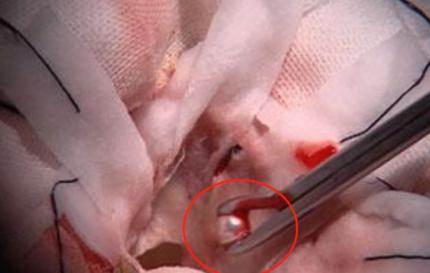 2006年，成都一女子在开颅手术时，医生却看到惊奇一幕，她的脑中竟然发现一颗颗像