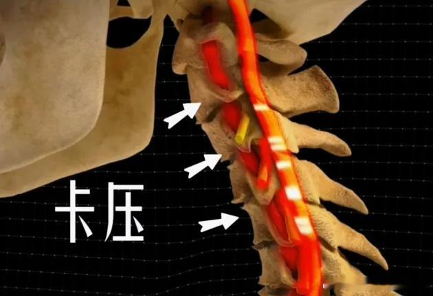 颈椎反弓昨天说了颈椎曲度变直，今天再给大家讲更深一种程度的——颈椎反弓【症状】