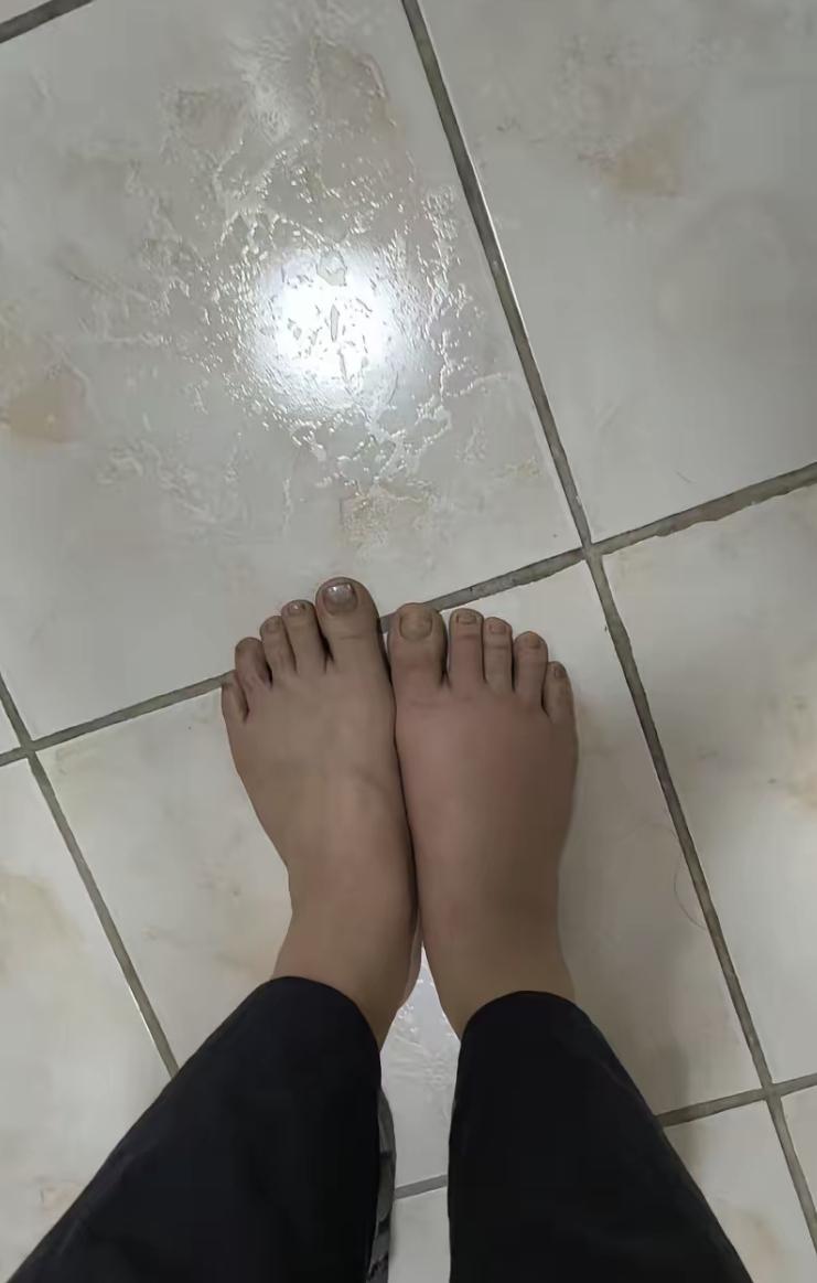 最近遇到个怪事,脚一直肿了四个月,去医院拍片验血都正常,吃了中药扎了针灸也没用。