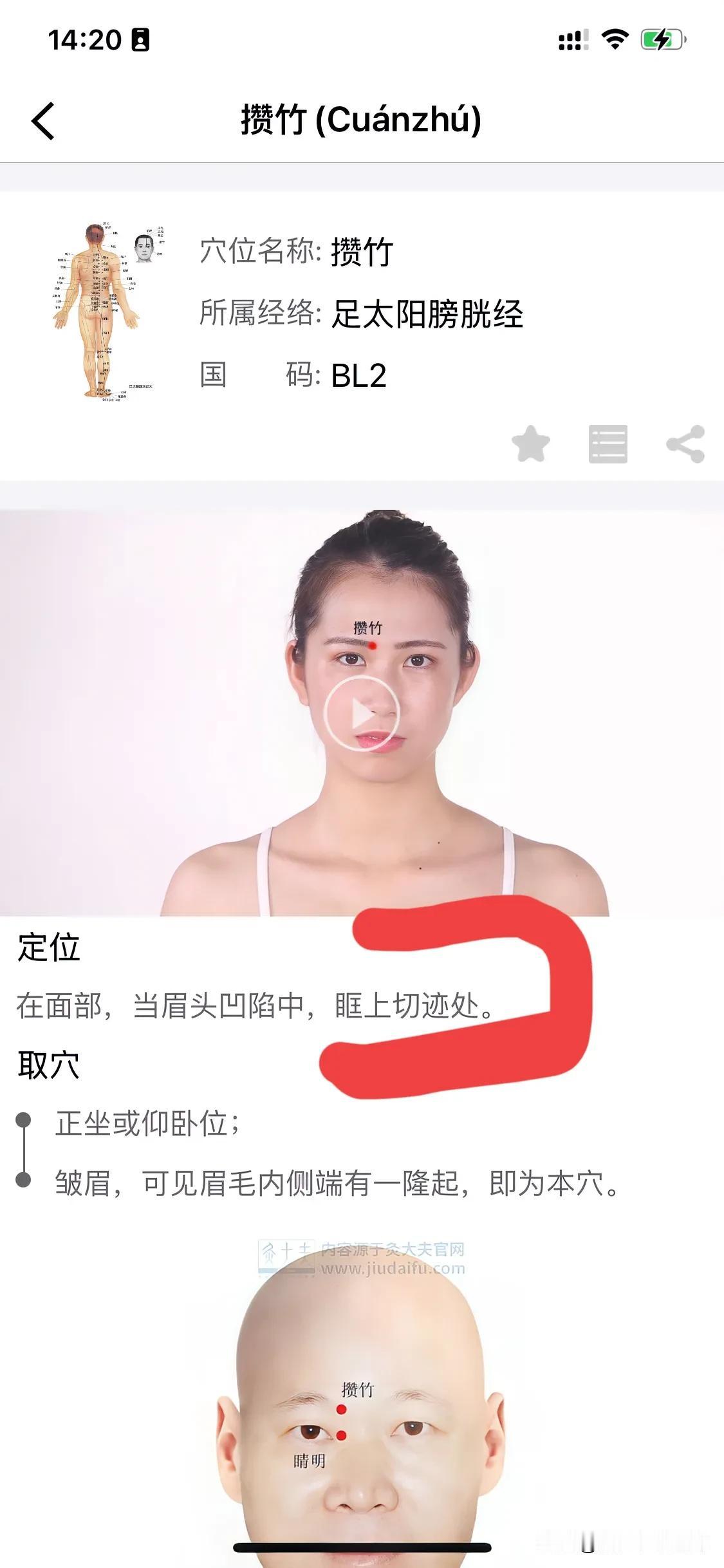 穴位修正软件错误:如下某软件上显示，攒竹穴：在眶上切迹处。国标定位:攒竹Cu