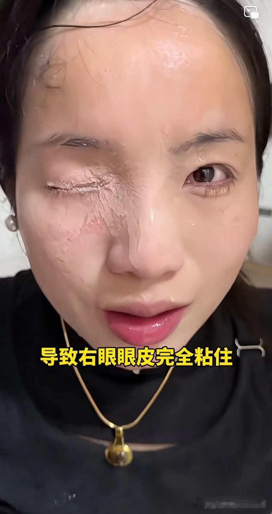 近日，贵州贵阳，何女士在贴美甲片的时候，不小心把502胶水喷洒进了右眼和鼻子，