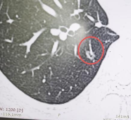 “肺结节考虑是原位癌或者微浸润癌，可不可以做消融？我就是害怕开刀！”门诊经常会遇