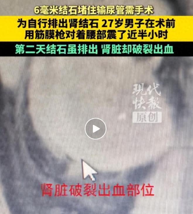 要钱不要命！9月1日报道，27岁南京小伙查出输尿管有颗6毫米结石，本来医生已经安