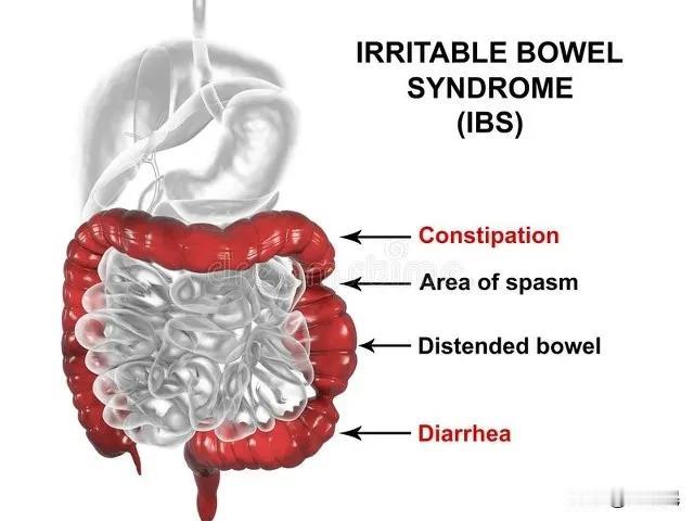 判断是否为肠易激综合征（IBS），主要从以下几个方面着手：一、典型症状：