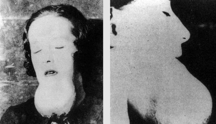 1922年，25岁少女因牙疼就医，医生刚一碰牙，她的下颚骨竟如灰烬般碎裂。短短4