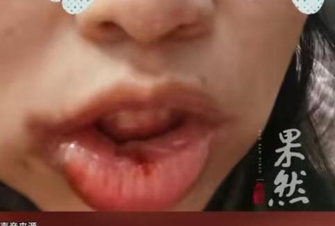 女子要备孕，就想提前把智齿拔掉，结果牙齿一拔，她整个舌头都没有知觉了，整个舌头就