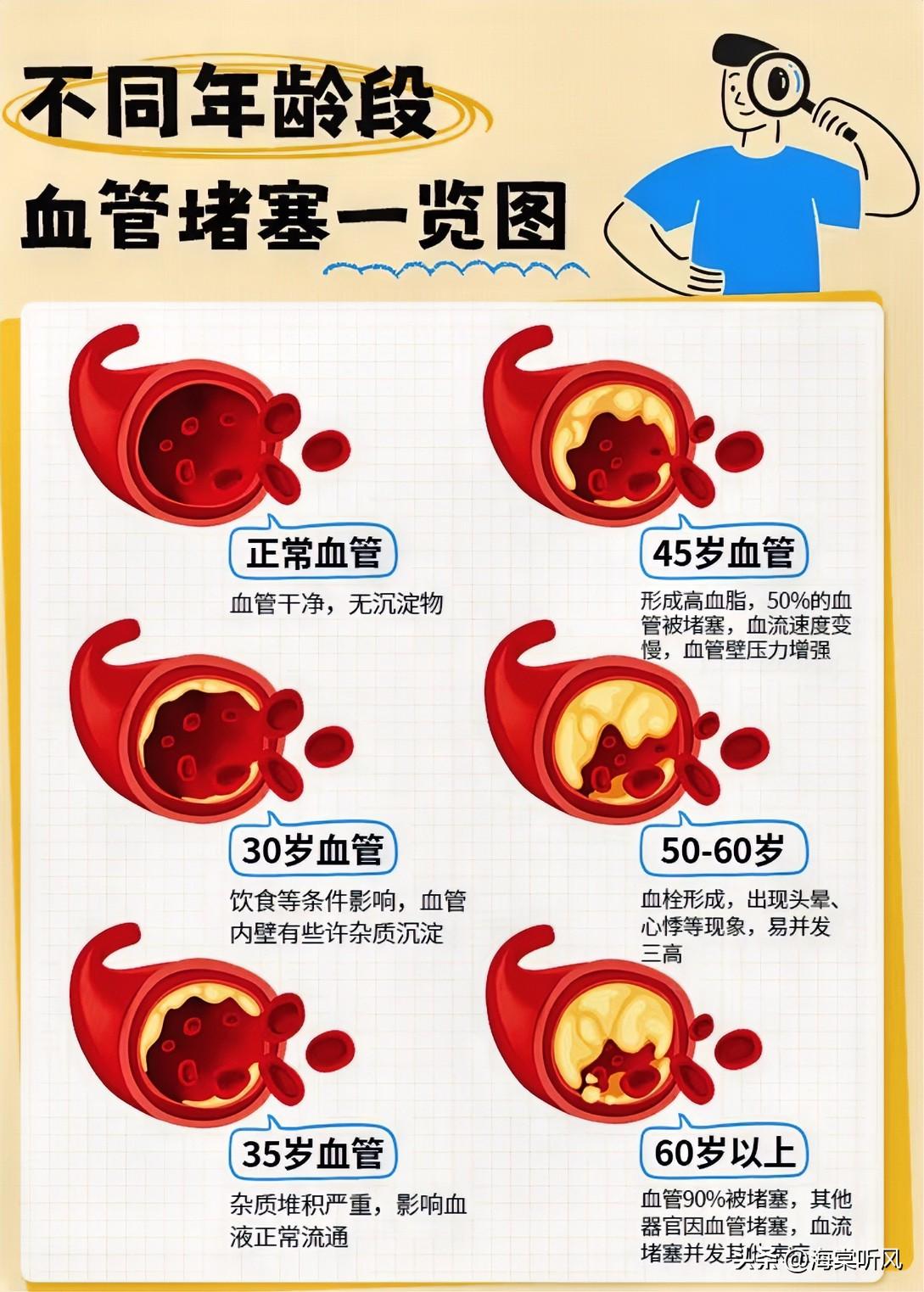 为什么越来越多的人出现血管堵塞?1.吃得太“好”了现在生活条件上去了，顿顿