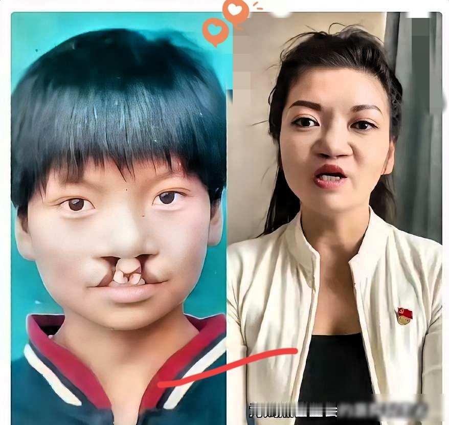 大家发现了没有，为什么那7000例免费治疗唇腭裂患者很少有人站出来帮李亚鹏发声，